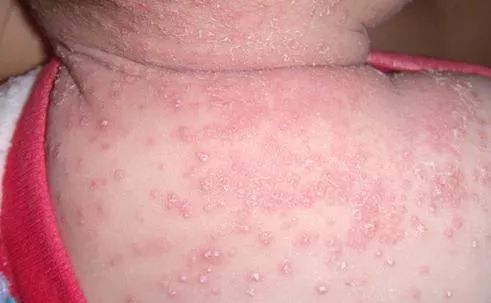 为什么脸上的痘痘那么难消,你脸上的痘痘是螨虫痘吗