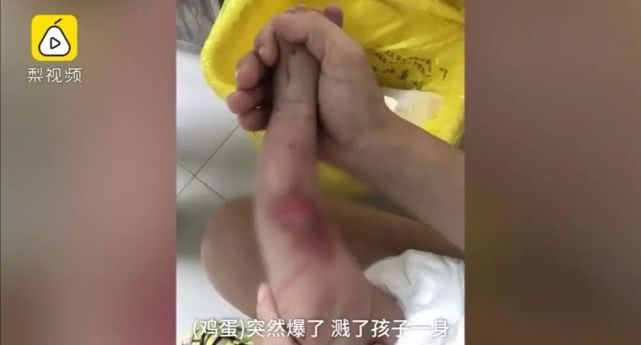 心疼！菏泽一月嫂抱仅40天男婴做饭时锅中鸡蛋突然爆开，孩子腿和肚皮烫出了泡...