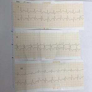 肺癌介入栓塞术后并发症,肺癌术后肺栓塞的病历模板