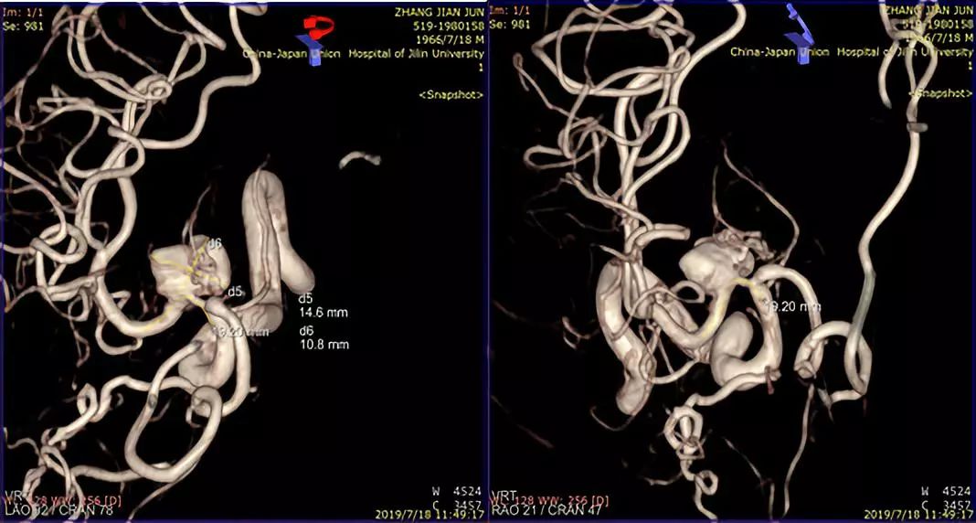 治疗颅内动脉瘤新型密网支架,pipeline治疗椎动脉夹层动脉瘤