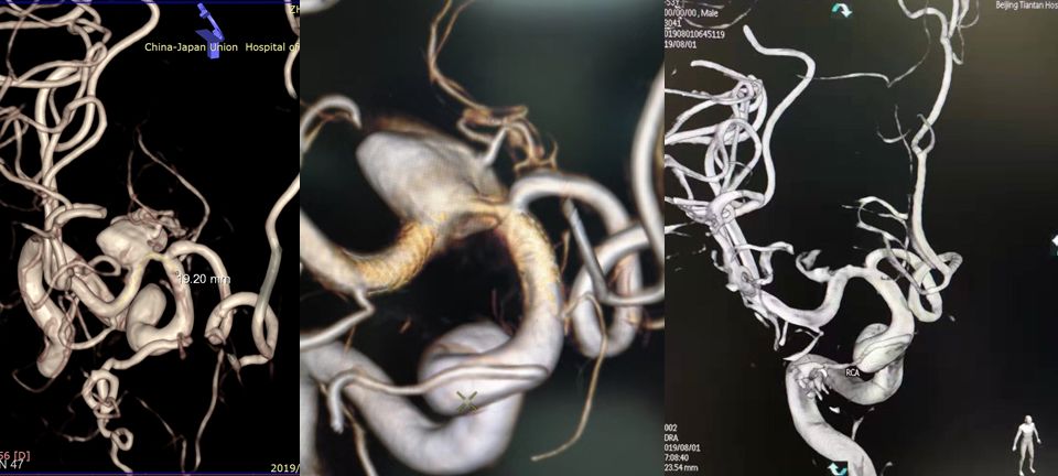 治疗颅内动脉瘤新型密网支架,密网支架处理动脉瘤的风险