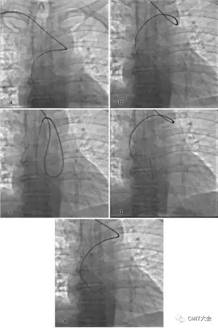 冠脉造影技术成熟不,跟我学技术分析从入门到精通