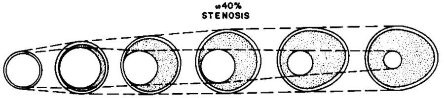 冠脉病变正性和负性重构,冠状动脉正向重构