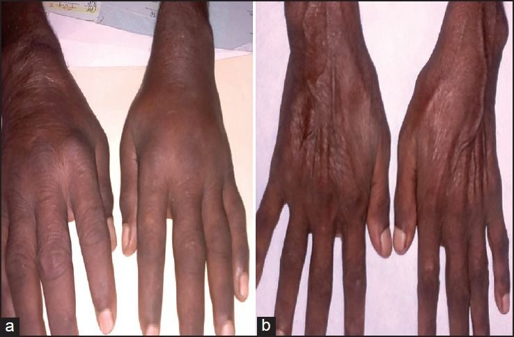 科普小知识你知道什么是关节炎吗,一般常见的关节炎症状有哪些