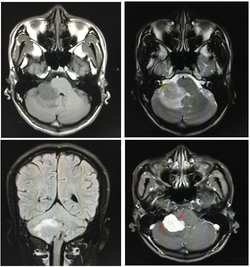 平山病、MELAS、MVNT、ODS丨3分钟读片·第15期