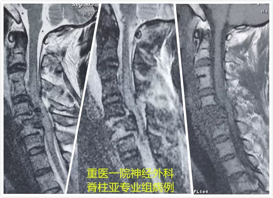 颈椎骨折脱位合并脊髓损伤,颈椎骨折脊髓损伤案例