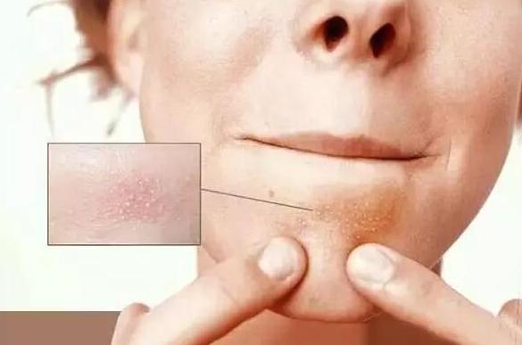 下巴上的螨虫用什么护肤品去除,下巴长螨虫有什么症状