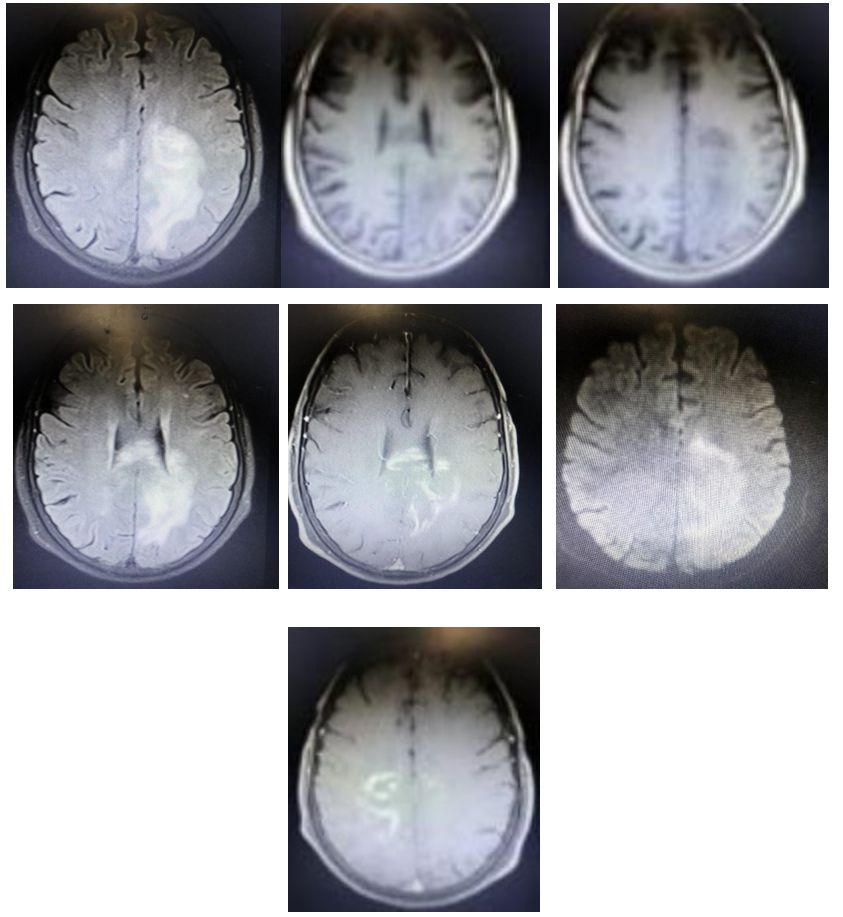 Whipple病、纹状体手、神经结节病、脱髓鞘假瘤丨3分钟读片·第16期