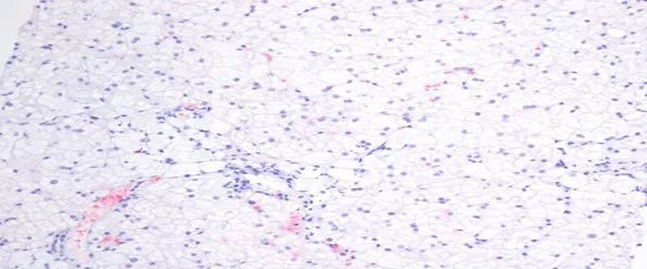 肝功能异常病例,肝功能异常10大病因