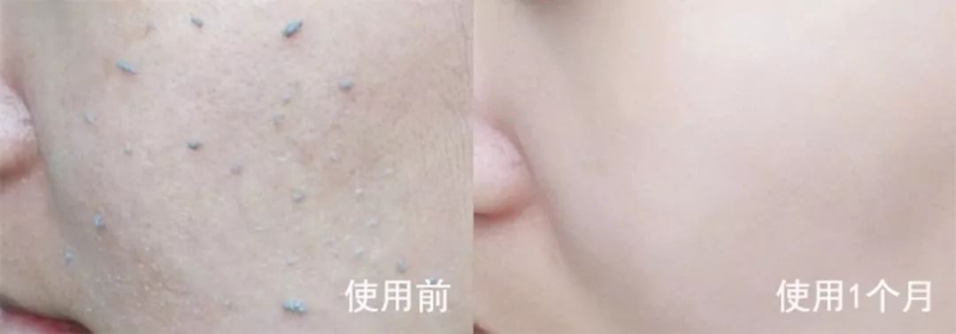 去黑头角质平价水乳,去黑头日本洗面奶