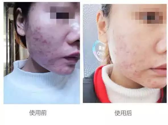 哪个牌子的壬二酸凝胶好,首博尔壬二酸清痘凝胶副作用