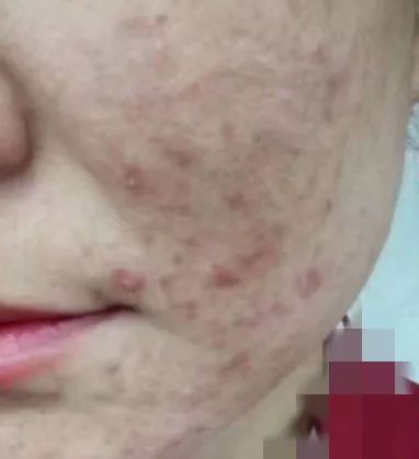 哪个牌子的壬二酸凝胶好,首博尔壬二酸清痘凝胶副作用