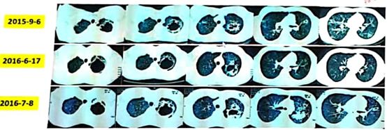 这例患者是呼吸道感染吗？｜病例分享