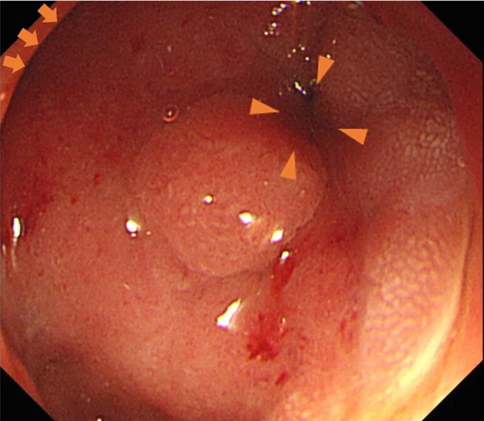 十二指肠腺癌累及胰腺算转移吗,罕见异位嗜铬细胞瘤1例