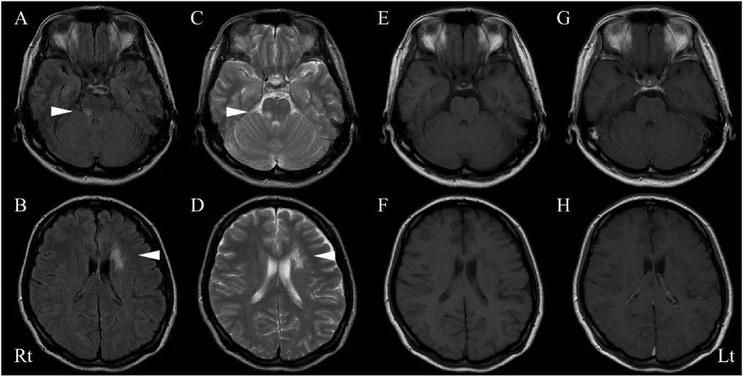 mog抗体阳性脑炎能活多久,mog抗体相关性脑炎治愈