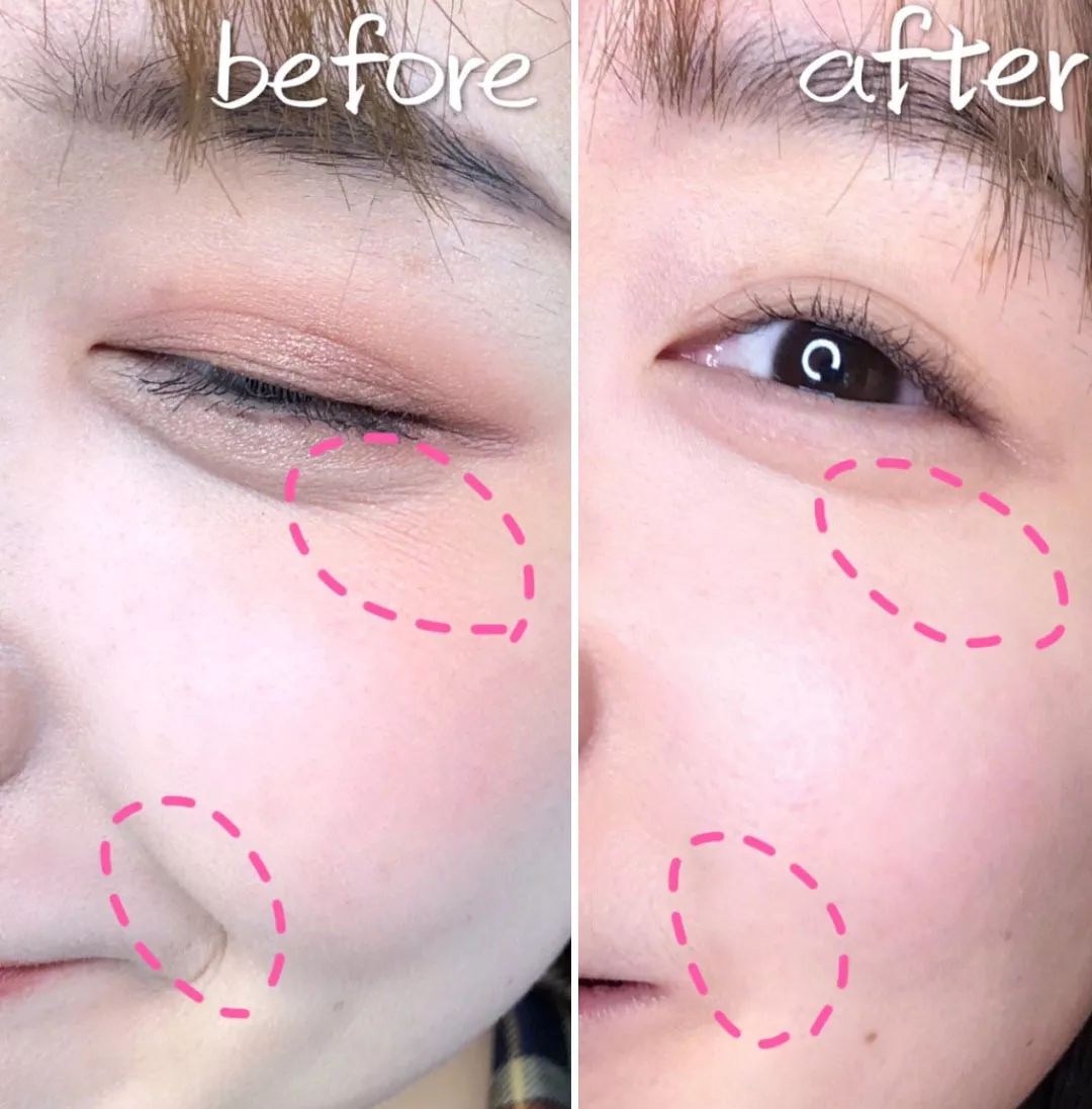 法令纹和眼纹怎么才能有效改善,法令纹贴眼贴有用吗