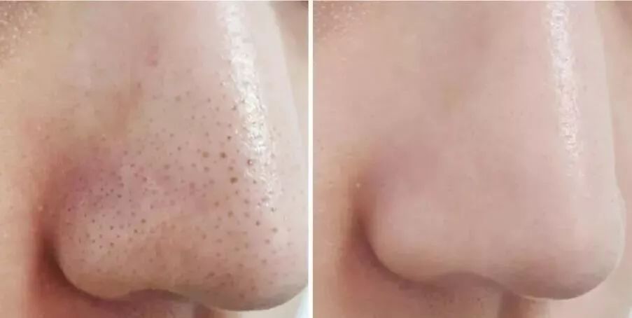 拒绝草莓鼻夹子夹出粉刺,拒绝草莓鼻毛孔粗大