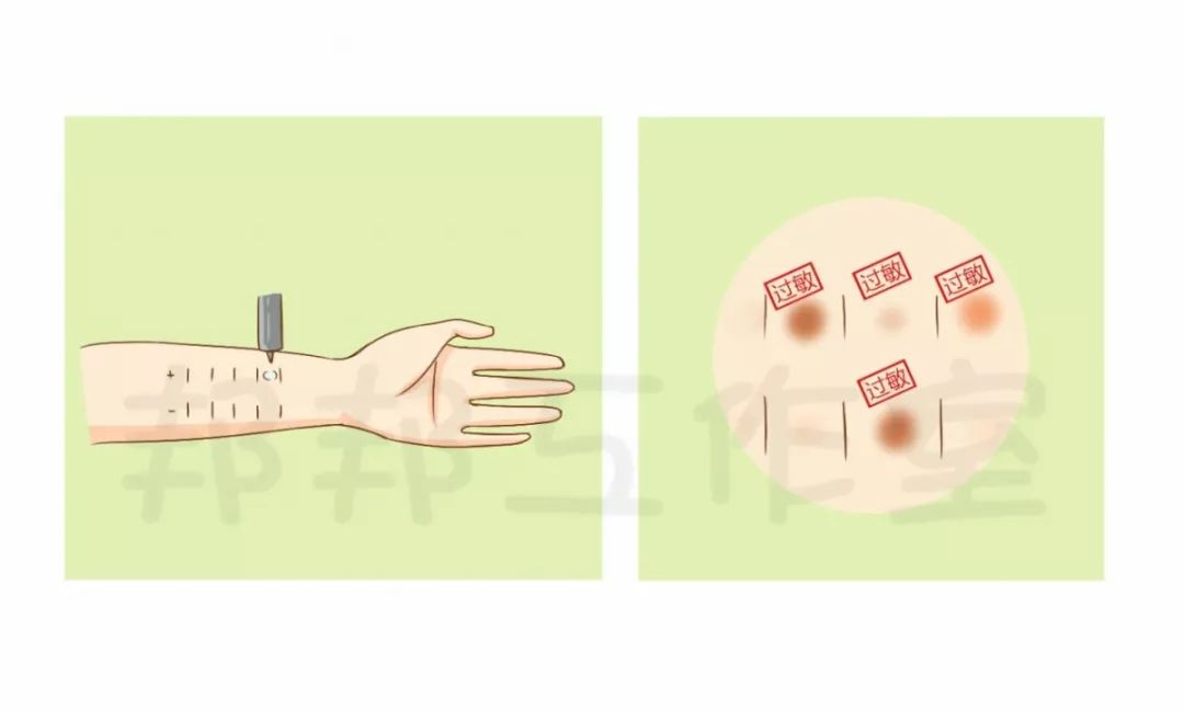 过敏性鼻炎过敏原检测方法,过敏性鼻炎过敏原怎么检测