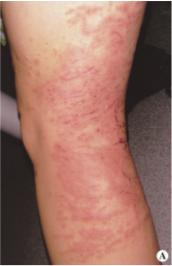 好书推荐｜《皮肤病彩*图色**谱》（第4版）