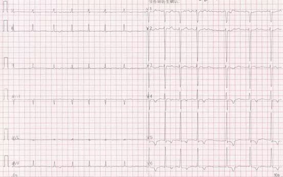 专栏丨贾卫滨：心电图“掉头”现象的定义与诊断特征（1）
