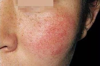 去*血丝红**有效的方法?三步法告别大红脸