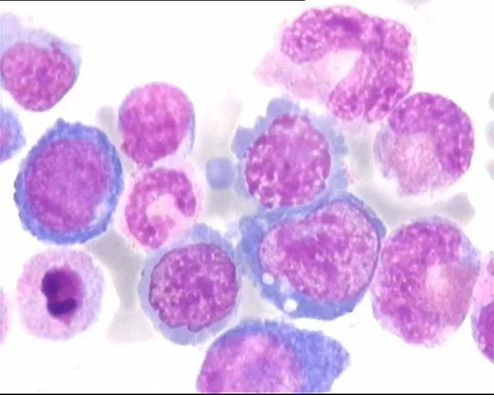 全血细胞减少疾病，你还傻傻分不清？