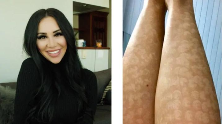 女子激光脱毛腿部长满红疹,女子脱毛手术后20天死亡