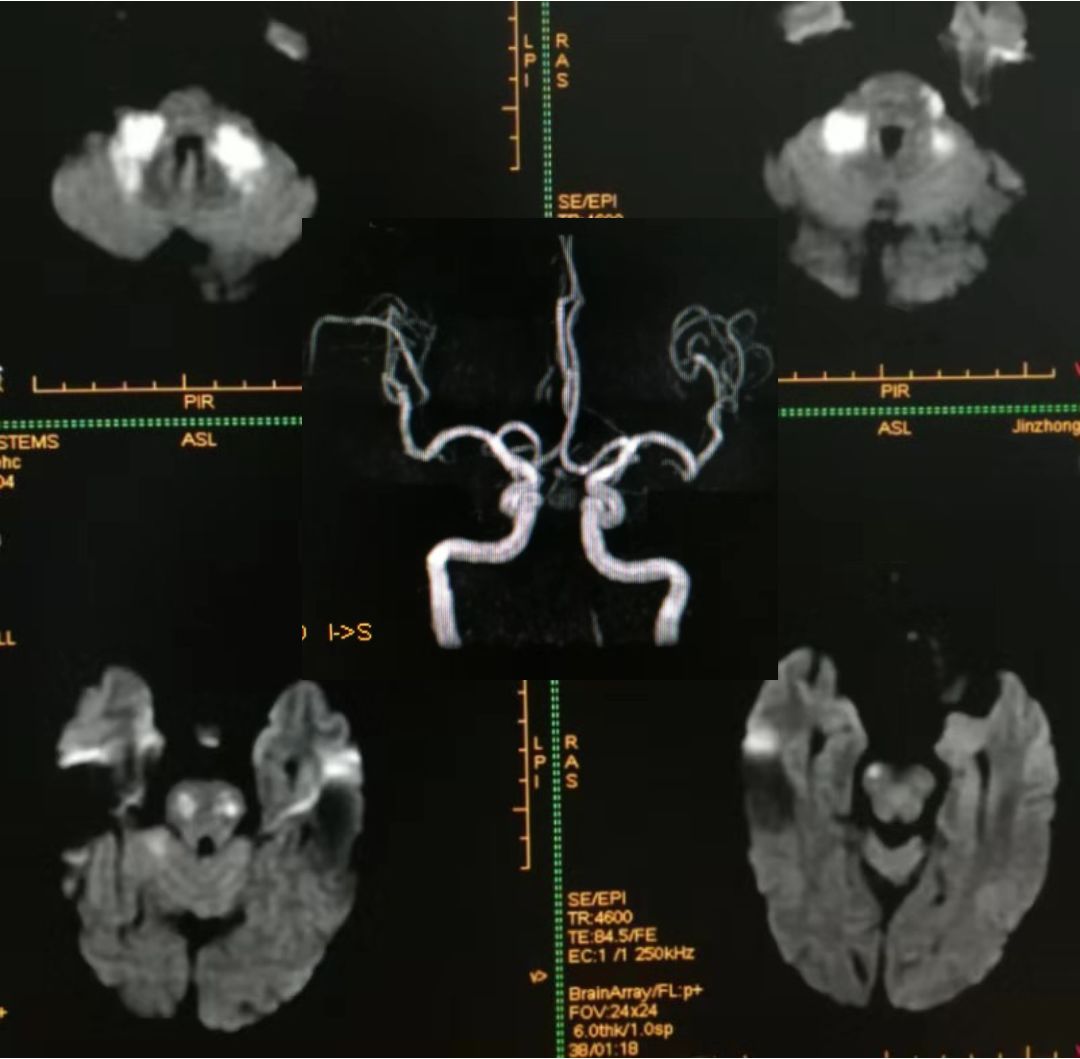 高氨血症有哪些表现,高氨血症