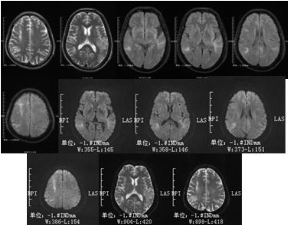 高氨血症有哪些表现,高氨血症