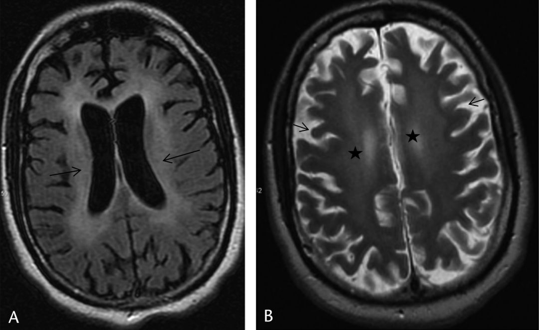 高氨血症有哪些表现,高氨血症