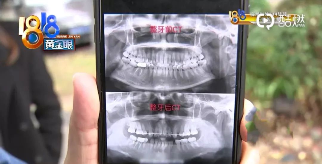 “美奥”矫正牙齿，发现不是连锁？换了医生后，牙齿开始外凸