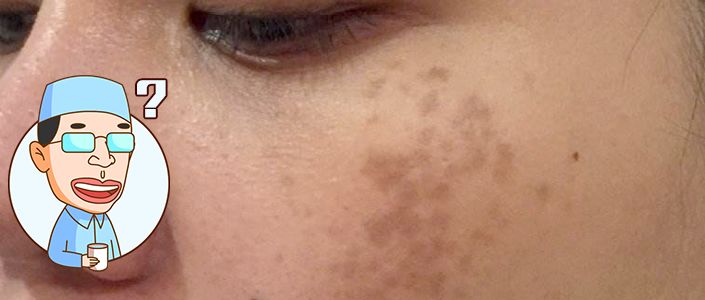 褐青色痣和斑的区别,褐青色痣斑是怎么形成的