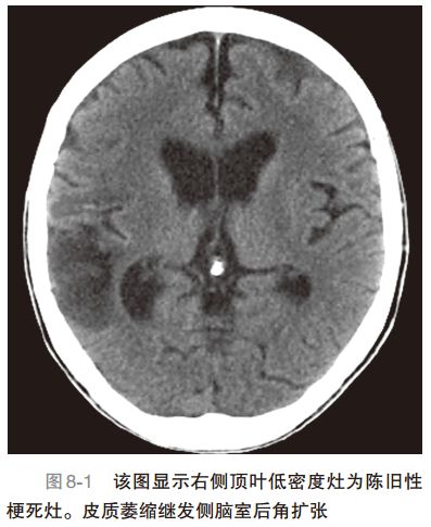 脑卒中精准tms治疗策略,急性缺血性脑卒中应对策略