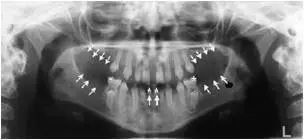 牙齿离奇失踪,牙齿诡异事件