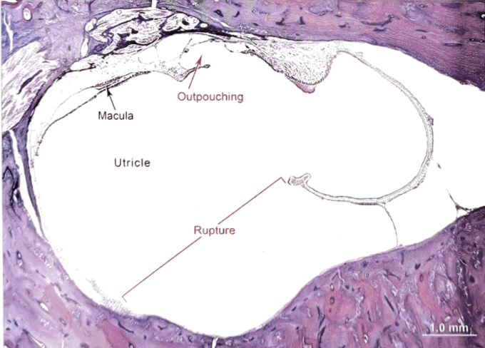22张图，细说梅尼埃病的组织病理学特点丨“晕”筹帷幄