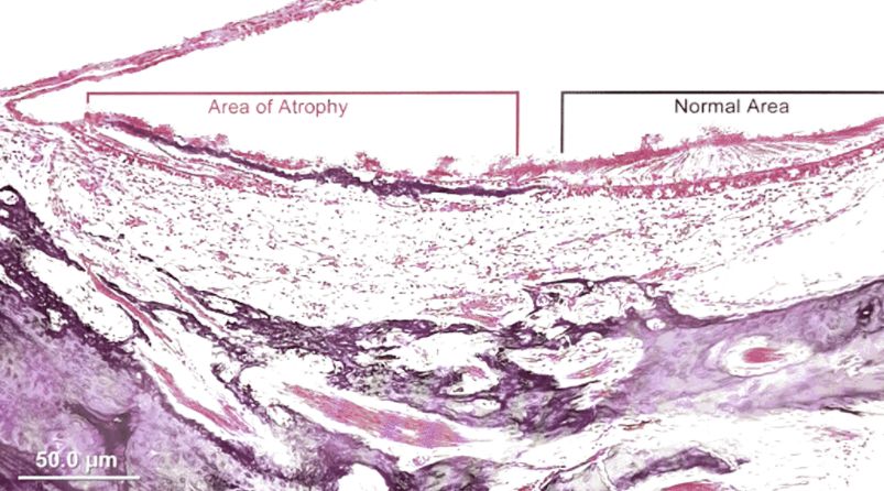 梅尼埃病深度解析,梅尼埃病病理解剖