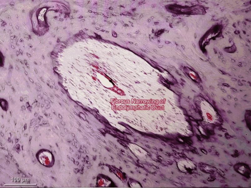 22张图，细说梅尼埃病的组织病理学特点丨“晕”筹帷幄