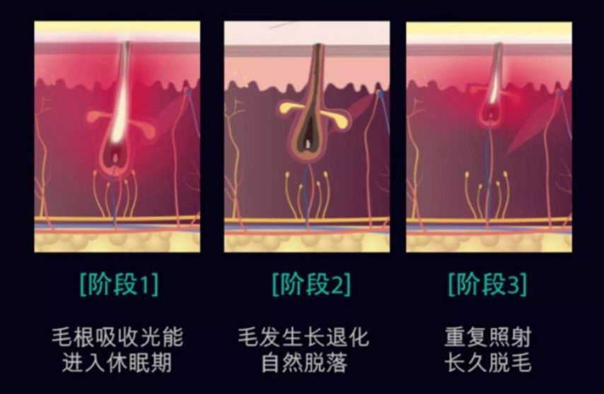 健康有效的脱毛方法,要美就要自律
