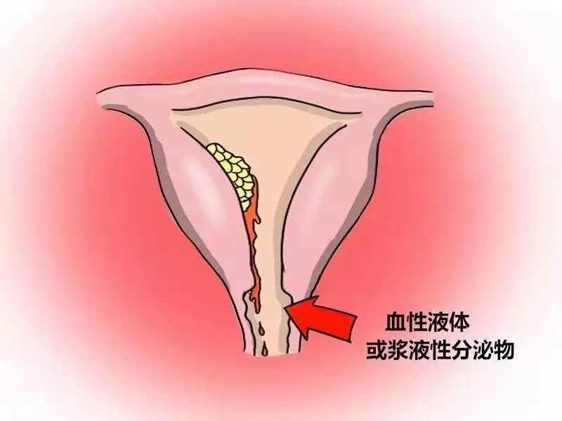 子宫内膜癌最新靶向药医保,子宫内膜癌靶向药多少钱