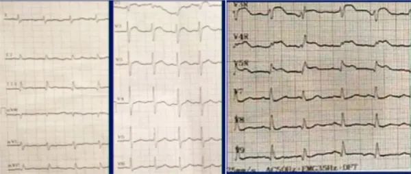 主动脉夹层真假腔鉴别超声示意图,主动脉夹层诊断中国专家共识