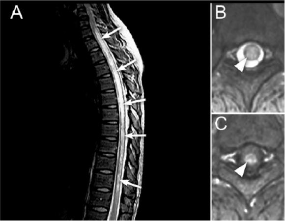张星虎视神经脊髓炎,张星虎多发性硬化