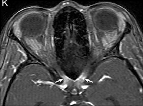 张星虎视神经脊髓炎,张星虎多发性硬化