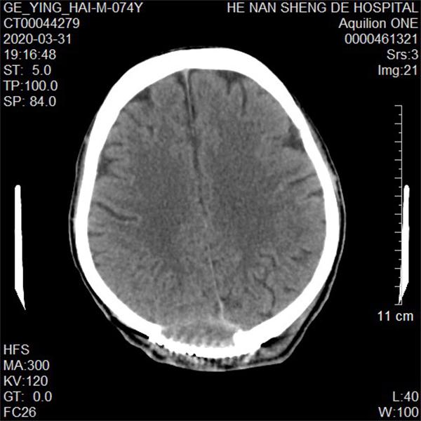 矢状窦旁脑膜瘤手术成功案例,天坛医院矢状窦旁脑膜瘤做手术