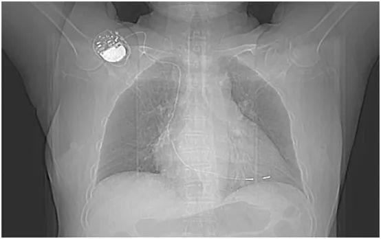心电图显示心室起搏,心电图电极v4位置