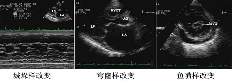 教你看懂心脏彩超五种心脏病,各种心脏瓣膜病特点