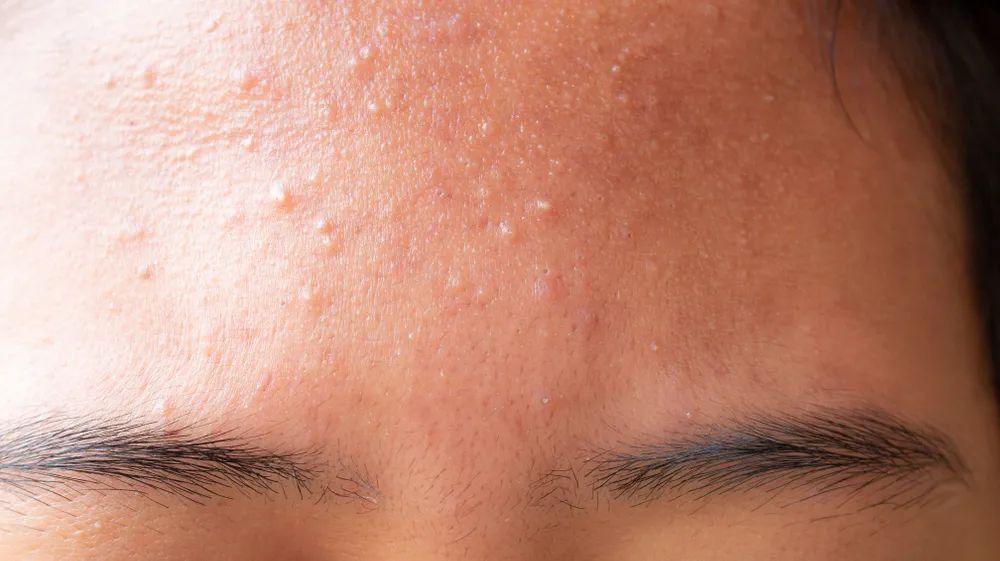 去闭口没脓痘痘的最佳方法,你不能不知道的去粉刺秘籍