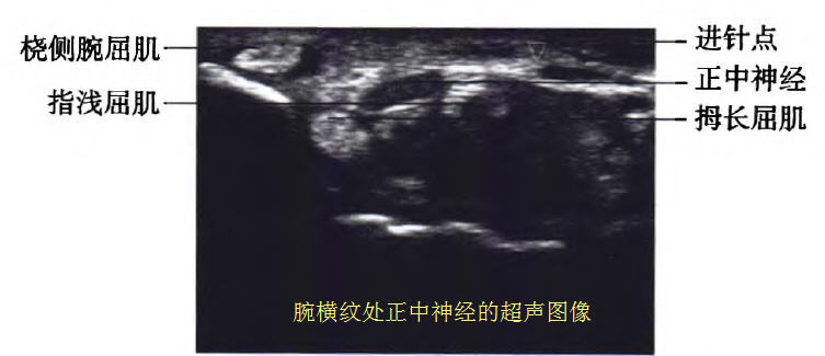 超声波注射治疗腕管综合征效果,超声引导局部注射治疗腕管综合征