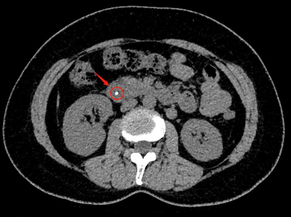 体内驱虫致癌案例,女子体内取出活虫原来吃了这道菜
