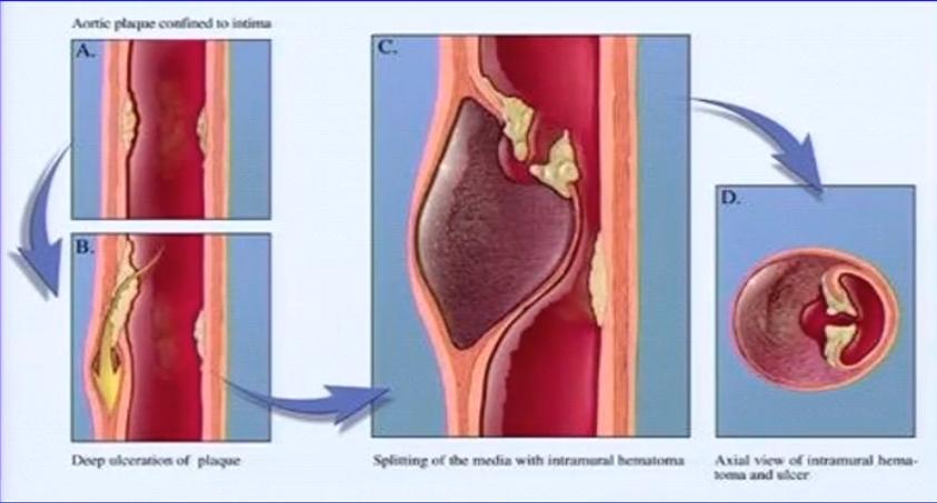 急性胸痛的理论知识,一图牢记急性胸痛的诊断流程