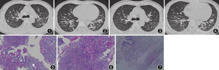 矽肺临床,急性纤维素性机化性肺炎